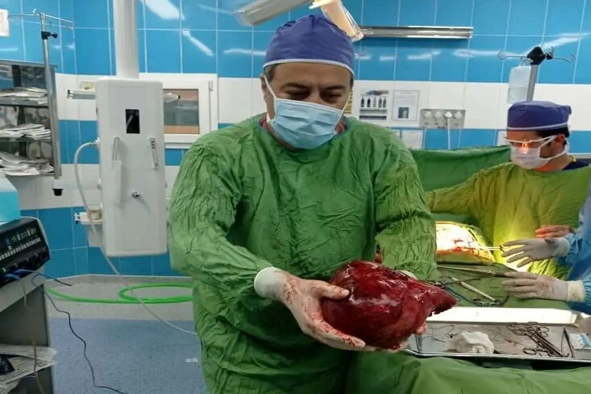 توده 3/5 کیلویی از کلیه یک بیمار خارج شد